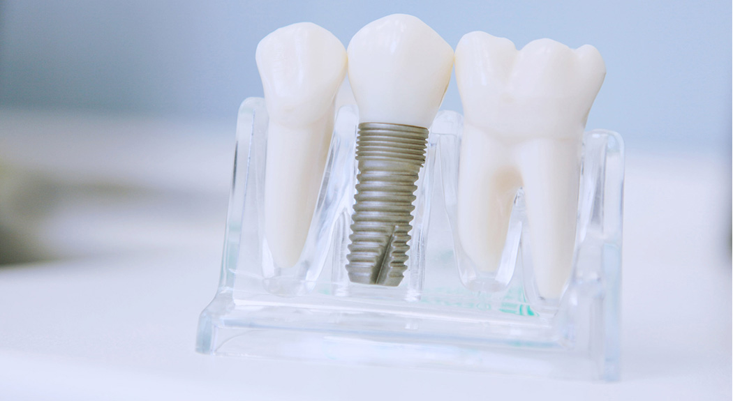 Зубные импланты сохраняют здоровые зубы