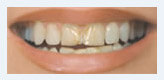Деформированные зубы с пятнами, промежутками