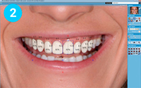 Диагностика исходных данных, определение типа формы зубов Подбор и дизайн моделей будущих зубов