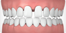 Широкие промежутки между зубами