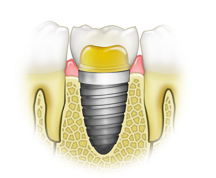 Функции зубных имплантов