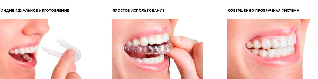 Выравнивание зубов и исправление прикуса прозрачными капами в стоматологии Гарант