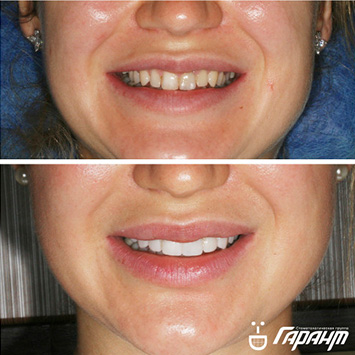 Фото зубов до и после