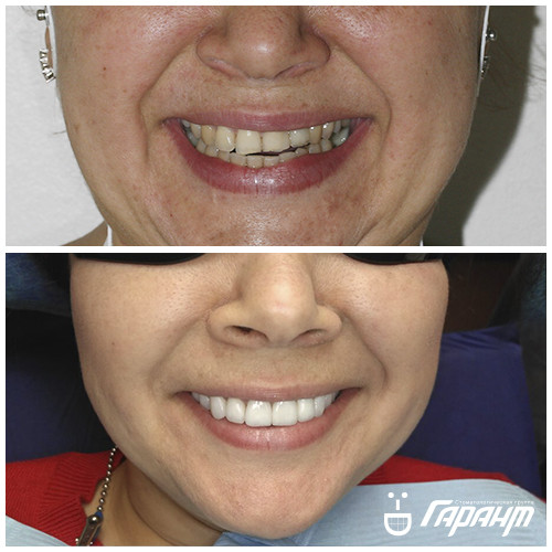 Фото до и после стоматологии ГАРАНТ