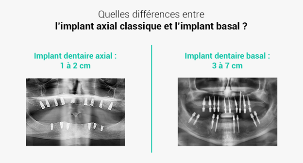 Отличия классического и базального имплантов 